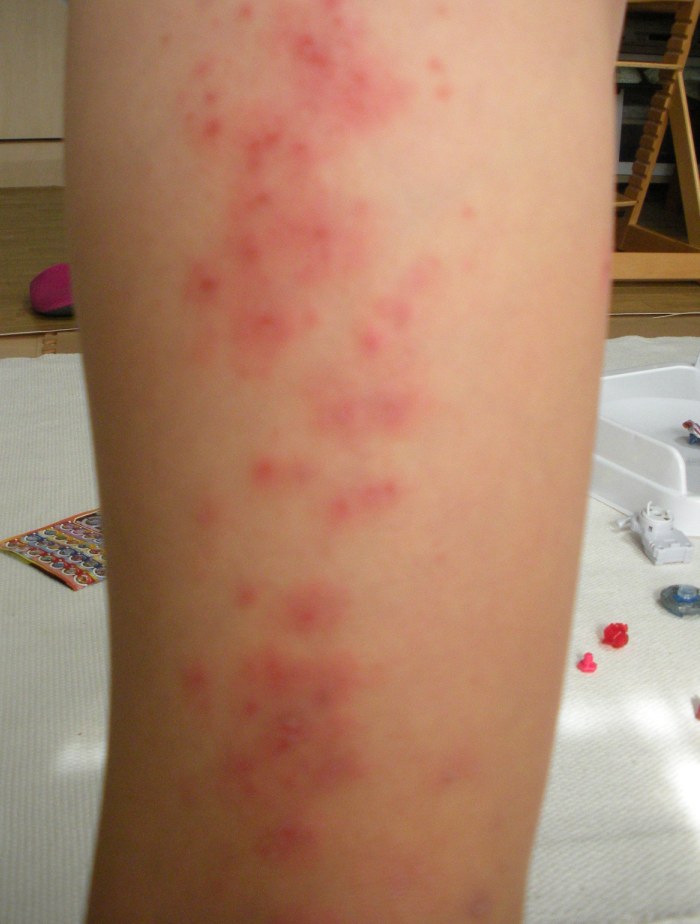 肌が乾燥して湿疹がでたときの対策